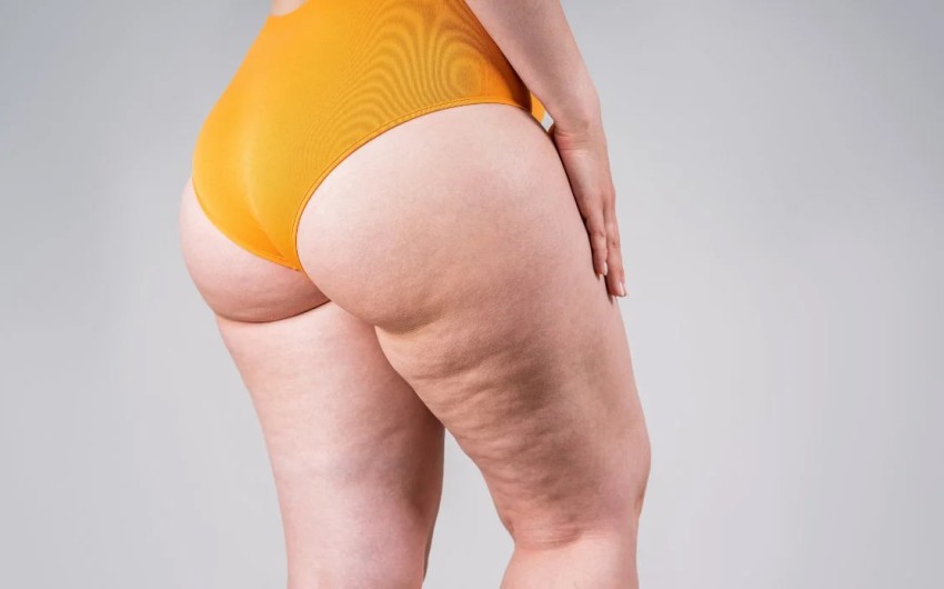 Lipedema.jpg