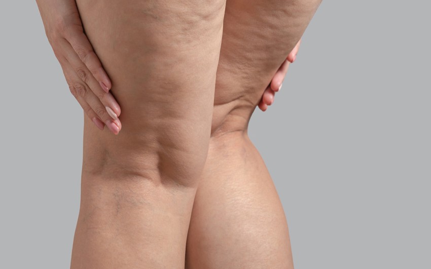 it-lipedema-cose-e-come-riconoscerlo_6387333b84019.jpg