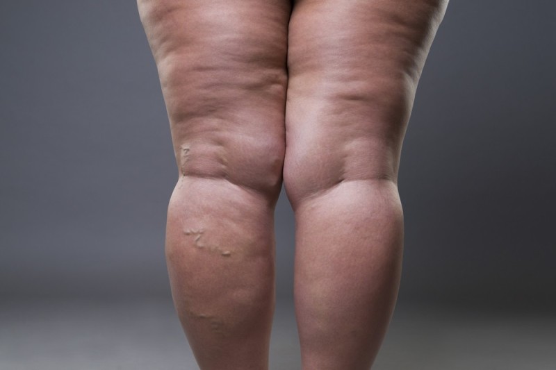 Lipedema