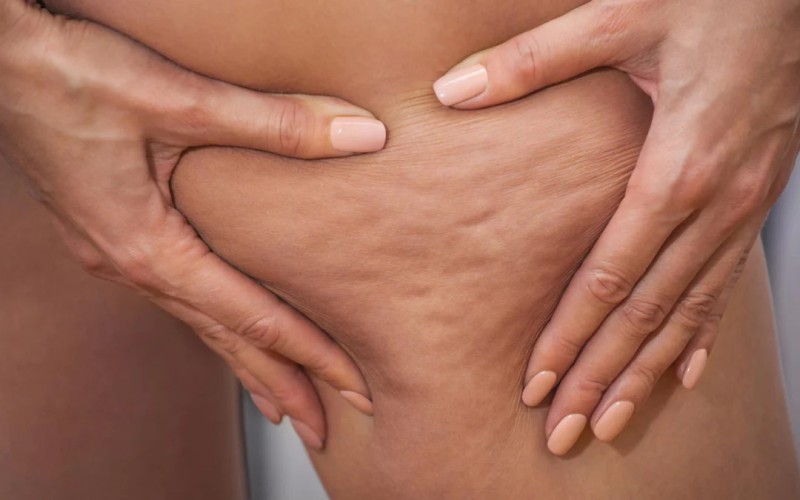 Cellulite (PEFS)
