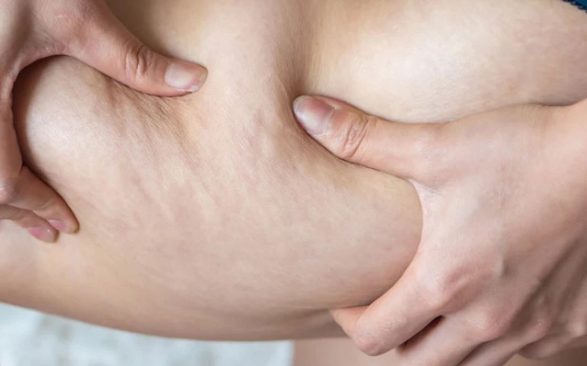 lipedema.jpg